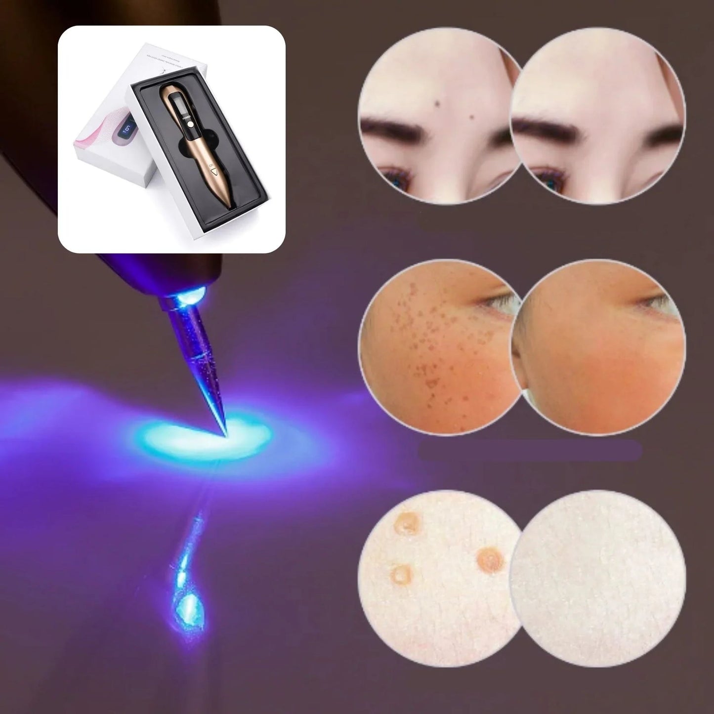 Elimina imperfecciones al instante con la Pluma Laser