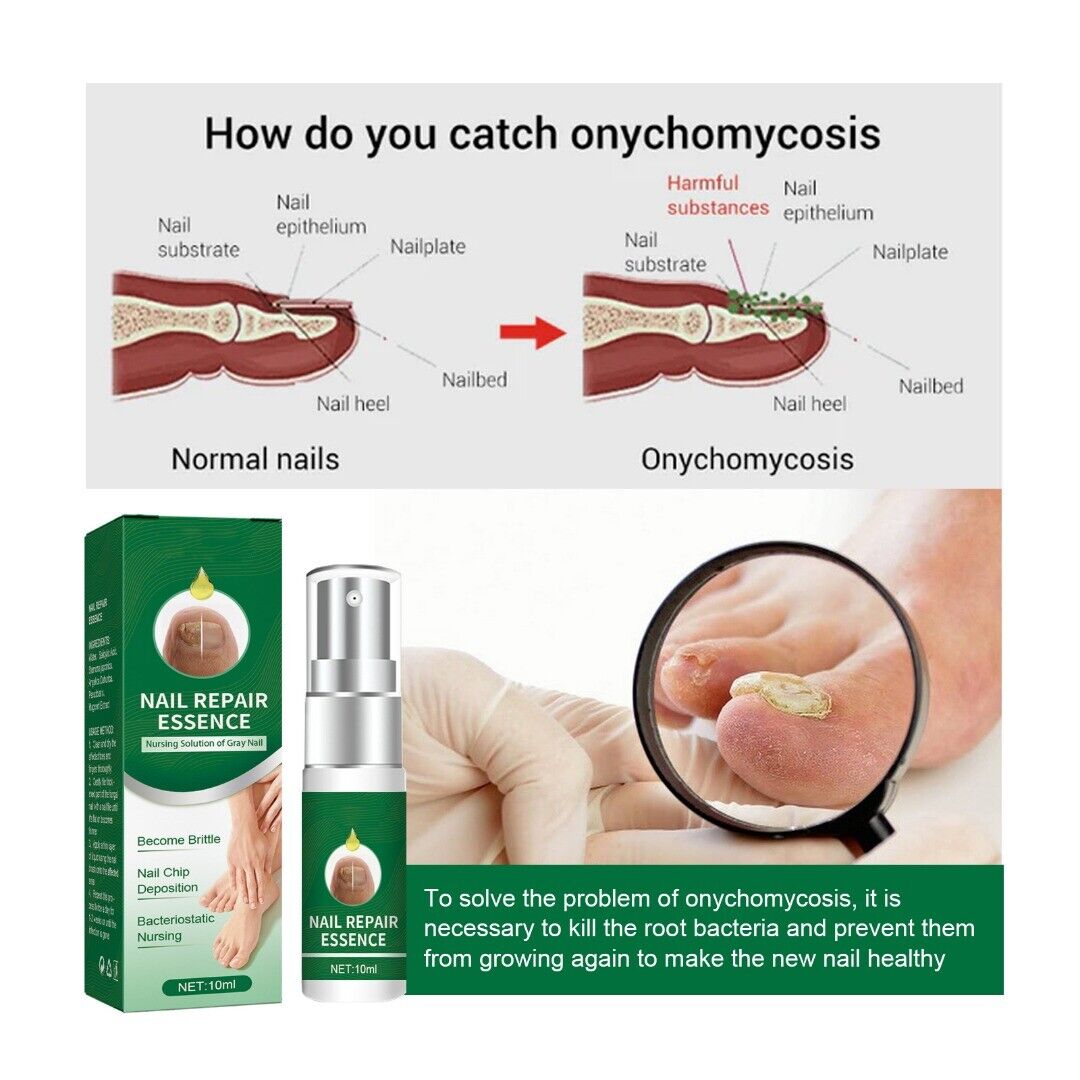 Suero para uñas con veneno de abeja-crecimiento y elimina hongos en 10 dias