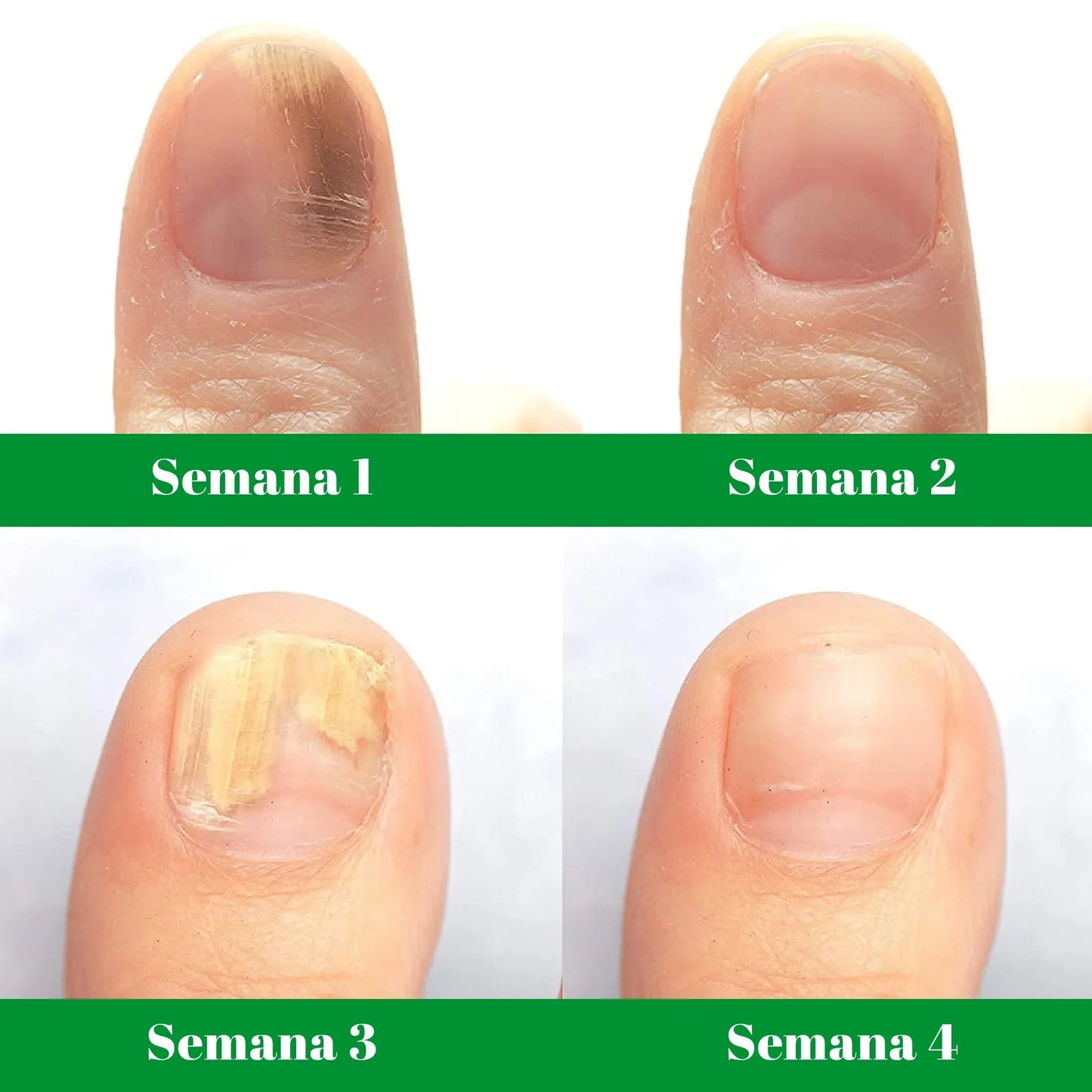 GOTAS DE TERBINAFINA PARA LOS HONGOS EN LAS UÑAS Y PIES