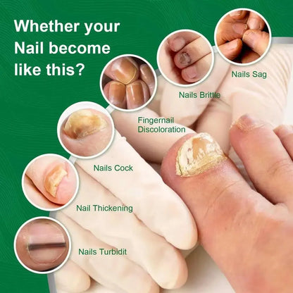 Suero para uñas con veneno de abeja-crecimiento y elimina hongos en 10 dias